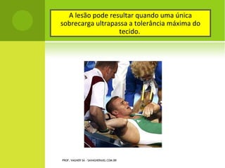 A lesão pode resultar quando uma única
sobrecarga ultrapassa a tolerância máxima do
                   tecido.




PROF. VAGNER SÁ - SAVAGNER@IG.COM.BR
 