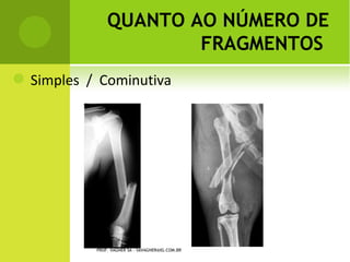 P ECTUS C ARINATUM




PROF. VAGNER SÁ - SAVAGNER@IG.COM.BR
 