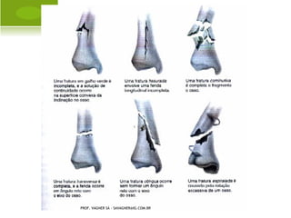 P ECTUS E XCAVATUM
                                                   Ó RTESE




PROF. VAGNER SÁ - SAVAGNER@IG.COM.BR
 