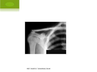 A USÊNCIA C ONGÊNITA U LNA




PROF. VAGNER SÁ - SAVAGNER@IG.COM.BR
 