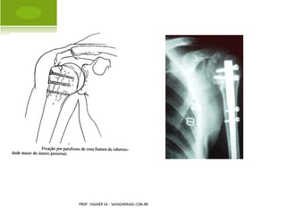 A MPUTAÇÃO CONGÊNITA




PROF. VAGNER SÁ - SAVAGNER@IG.COM.BR
 