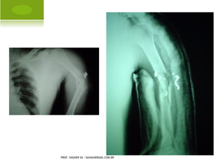 A MPUTAÇÃO CONGÊNITA




PROF. VAGNER SÁ - SAVAGNER@IG.COM.BR
 