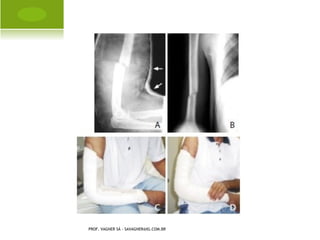 M ÃO F ENDIDA




PROF. VAGNER SÁ - SAVAGNER@IG.COM.BR
 