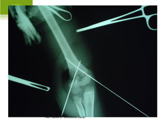 A NOMALIAS CONGÊNITAS DOS
MEMBROS INFERIORES




PROF. VAGNER SÁ -
SAVAGNER@IG.COM.BR
 