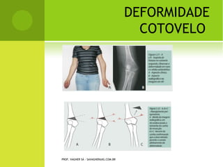 D ISPLASIA DO QUADRIL
L UXAÇÃO C ONGÊNITA Q UADRIL




 PROF. VAGNER SÁ - SAVAGNER@IG.COM.BR
 