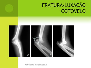 D ISPLASIA DO QUADRIL
L UXAÇÃO C ONGÊNITA Q UADRIL




 PROF. VAGNER SÁ - SAVAGNER@IG.COM.BR
 