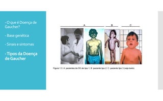 -Oqueé Doença de
Gaucher?
- Base genética
-Sinais esintomas
-Tipos da Doença
deGaucher
 