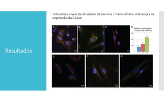 Resultados
 Diferentes níveis de atividade GCase nos irmãos refletiu diferenças na
expressão da GCase
 