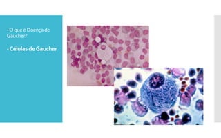 -Oqueé Doença de
Gaucher?
-CélulasdeGaucher
 