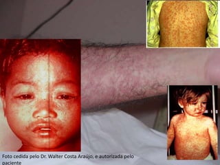 Foto cedida pelo Dr. Walter Costa Araújo, e autorizada pelo
paciente
 