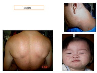Rubéola
 