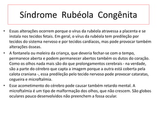 Síndrome Rubéola Congênita
• Essas alterações ocorrem porque o vírus da rubéola atravessa a placenta e se
instala nos tecidos fetais. Em geral, o vírus da rubéola tem predileção por
tecidos do sistema nervoso e por tecidos cardíacos, mas pode provocar também
alterações ósseas.
• A fontanela ou moleira da criança, que deveria fechar-se com o tempo,
permanece aberta e podem permanecer abertos também os dutos do coração.
Como os olhos nada mais são do que prolongamentos cerebrais - na verdade,
são a parte do cérebro que capta a imagem porque a outra está coberta pela
calota craniana -, essa predileção pelo tecido nervoso pode provocar cataratas,
cegueira e microftalmia.
• Esse acometimento do cérebro pode causar também retardo mental. A
microftalmia é um tipo de malformação dos olhos, que não crescem. São globos
oculares pouco desenvolvidos não preenchem a fossa ocular.
 