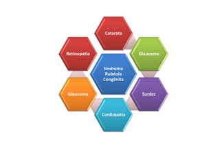 Síndrome
Rubéola
Congênita
Catarata
Glaucoma
Surdez
Cardiopatia
Glaucoma
Retinopatia
 