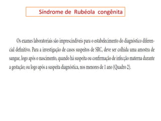 Síndrome de Rubéola congênita
 