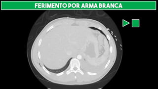 Ferimento por arma branca
 