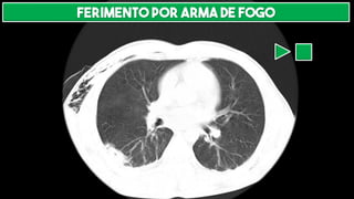 Ferimento por arma de fogo
 