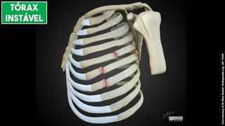 Case
courtesy
of
Dr
Matt
Skalski,
Radiopaedia.org,
rID:
71639
TÓRAX
INSTÁVEL
 