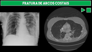 FRATURA DE ARCOS COSTAIS
 
