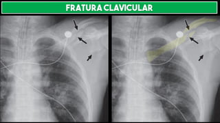 FRATURA CLAVICULAR
 