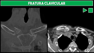 FRATURA CLAVICULAR
 