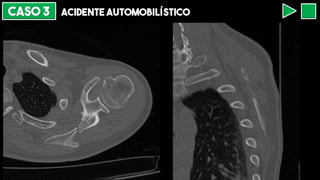 CASO 3 ACIDENTE AUTOMOBILÍSTICO
 