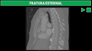 FRATURA ESTERNAL
 