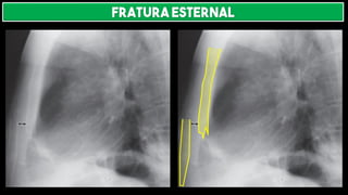 FRATURA ESTERNAL
 