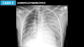 CASO 3 ACIDENTE AUTOMOBILÍSTICO
 