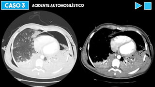 CASO 3 ACIDENTE AUTOMOBILÍSTICO
 