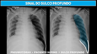 SINAL DO SULCO PROFUNDO
PNEUMOTÓRAX + PACIENTE SUPINO → SULCO PROFUNDO
 