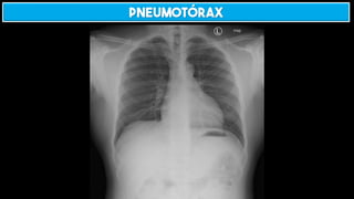 Pneumotórax
 