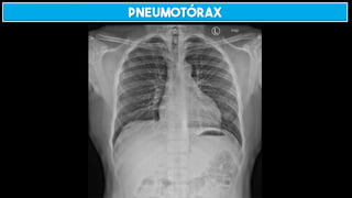 Pneumotórax
 