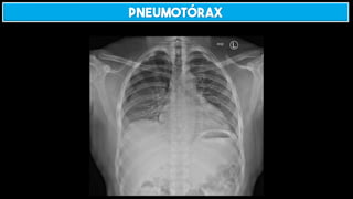 Pneumotórax
 