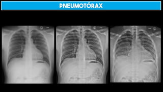 Pneumotórax
 