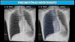 Pneumotórax hipertensivo
 