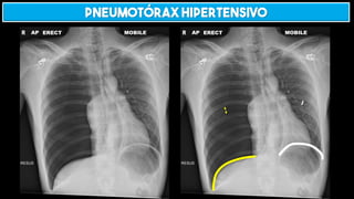 Pneumotórax hipertensivo
 