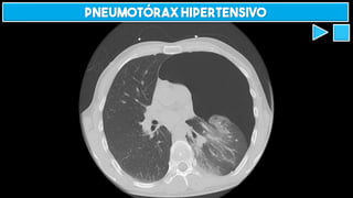 Pneumotórax hipertensivo
 