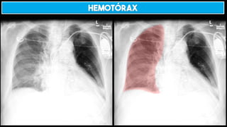 HEMOTÓRAX
 