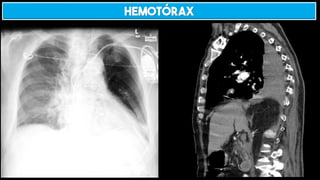 HEMOTÓRAX
 