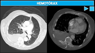 HEMOTÓRAX
 