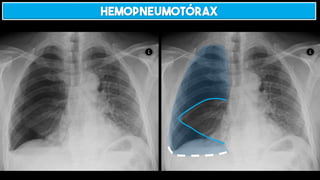 HEMOPNEUMOTÓRAX
 