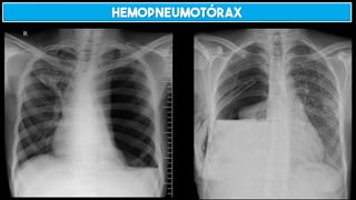 HEMOPNEUMOTÓRAX
 