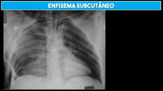 ENFISEMA SUBCUTÂNEO
 