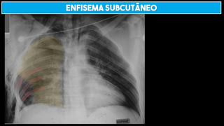 ENFISEMA SUBCUTÂNEO
 