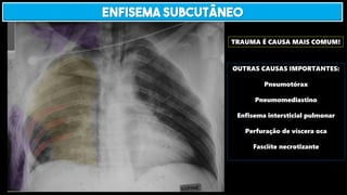 TRAUMA É CAUSA MAIS COMUM!
OUTRAS CAUSAS IMPORTANTES:
Pneumotórax
Pneumomediastino
Enfisema intersticial pulmonar
Perfuração de víscera oca
Fasciíte necrotizante
ENFISEMA SUBCUTÂNEO
 