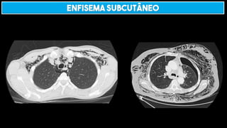 ENFISEMA SUBCUTÂNEO
 