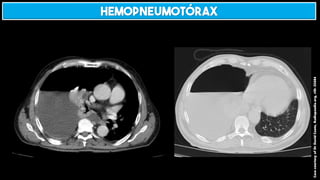 Case
courtesy
of
Dr
David
Cuete,
Radiopaedia.org,
rID:
25684
HEMOPNEUMOTÓRAX
 