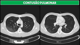 CONTUSÃO PULMONAR
 