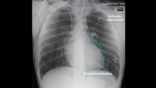 Enfisema
subcutâneo
Pneumomediastino
 