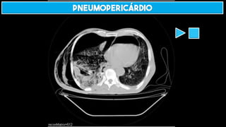 PNEUMOPERICÁRDIO
 